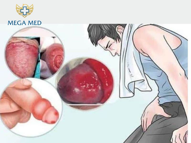 Vết thương bị nhiễm trùng